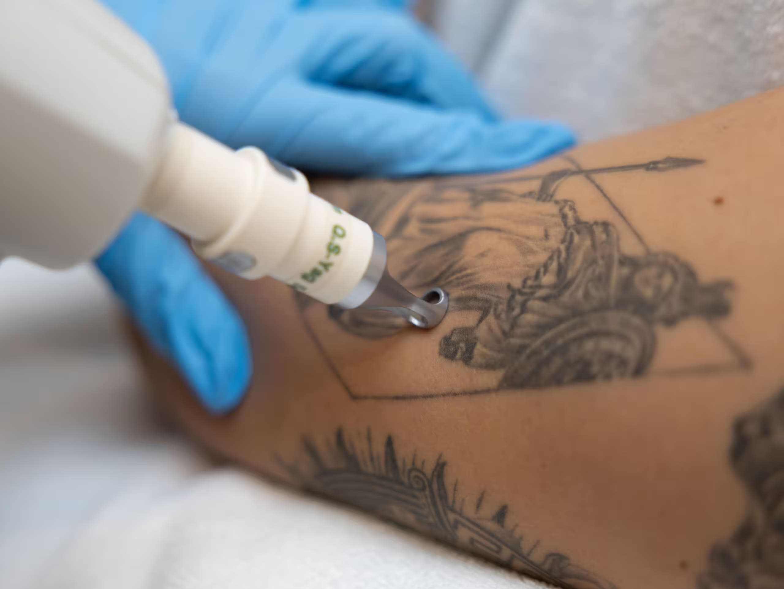 Laser Tattoo Removal