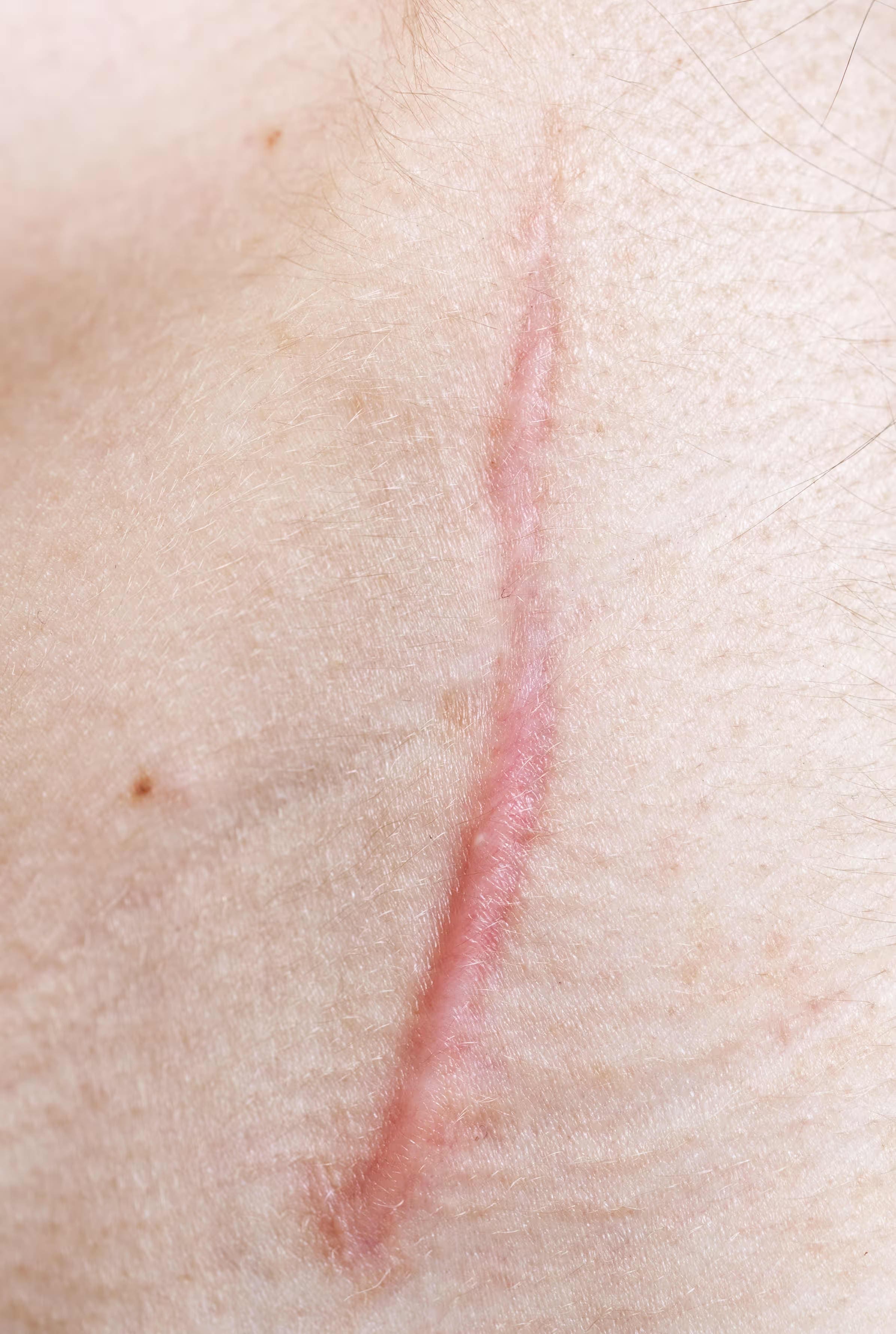 Surgical Scars Treatment