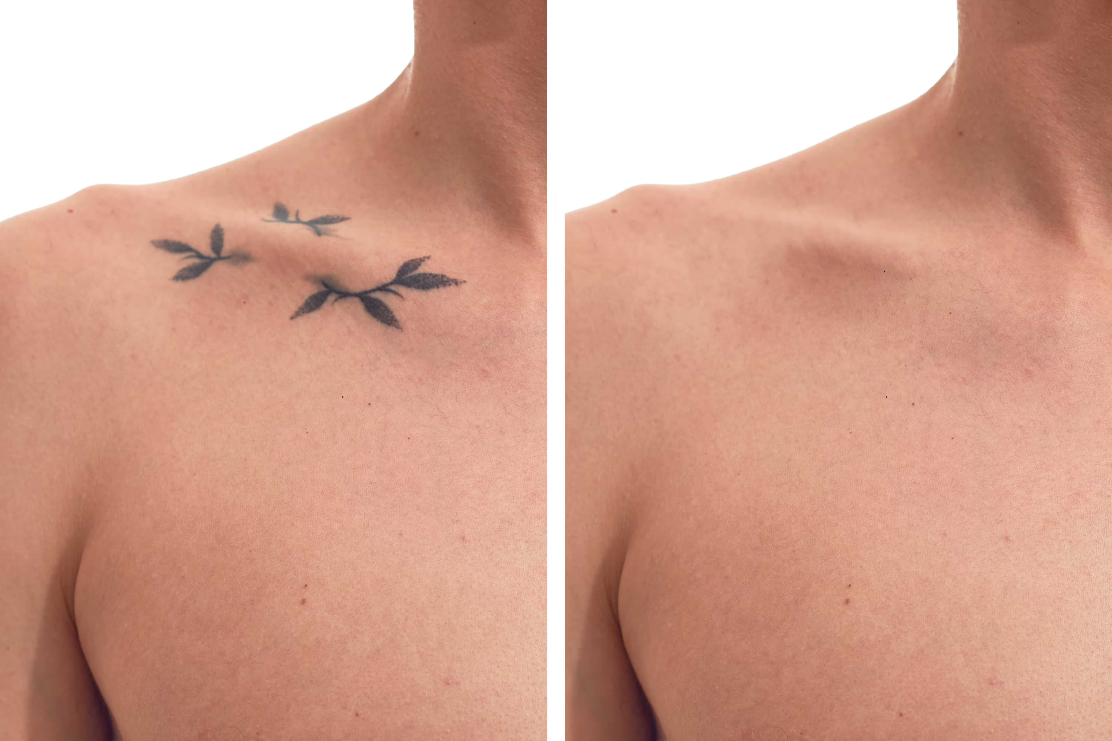 Laser tattoo removal procedure